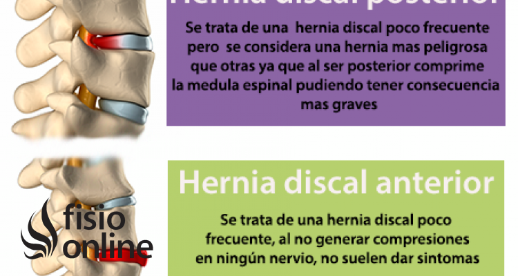 Las hernias discales pueden ser muy diferentes, aprende cómo son algunas de ellas