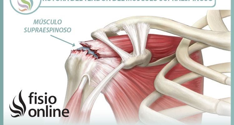 Rotura del  tendón del músculo supraespinoso, información y consejos para su prevención