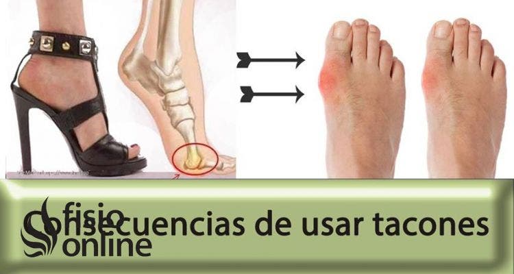 El juanete o hallux valgus, el castigo de la mujer con tacones