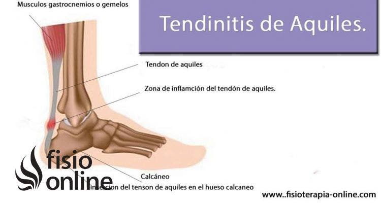 Tendinitis o tendinosis del tendón de Aquiles. Información, consejos y un útil automasaje