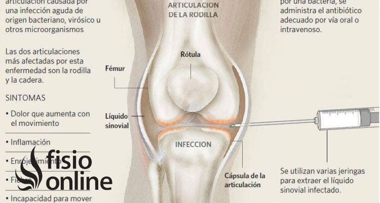 La artritis o inflamación articular, información, consejos y un clarificador vídeo sobre su origen, causas y tratamiento