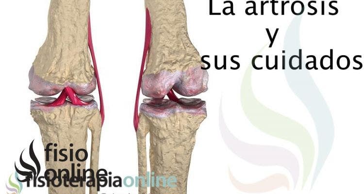 Cuida tu artrosis, te ofrecemos unos útiles consejos y recomendaciones