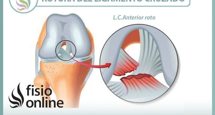 Rotura del ligamento cruzado de la rodilla, información consejos y un útil vídeo sobre el tema