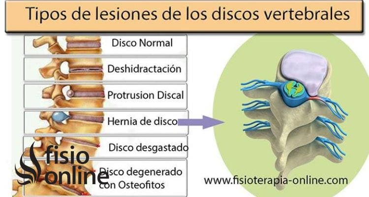 Las vértebras cervicales suelen sufrir lesiones, una de ellas es la hernia discal cervical descubre como y porque ocurre