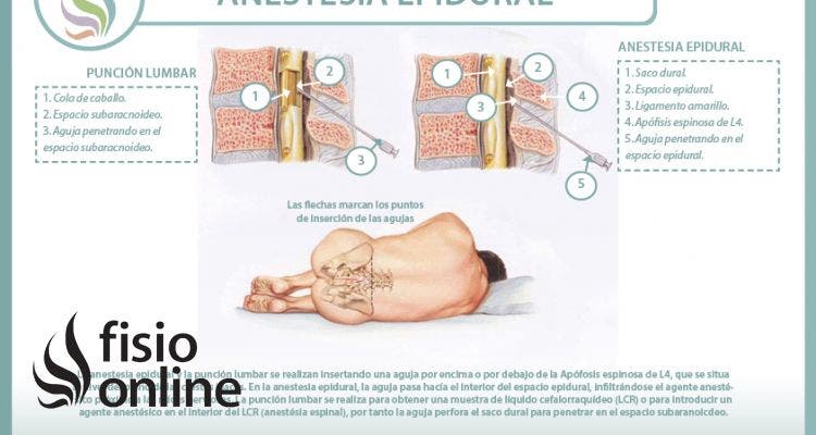 Anestesia epidural, descubre sus indicaciones y sus peligros