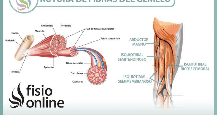 Rotura de fibras del gemelo o gastrocnemio, una lesión frecuente