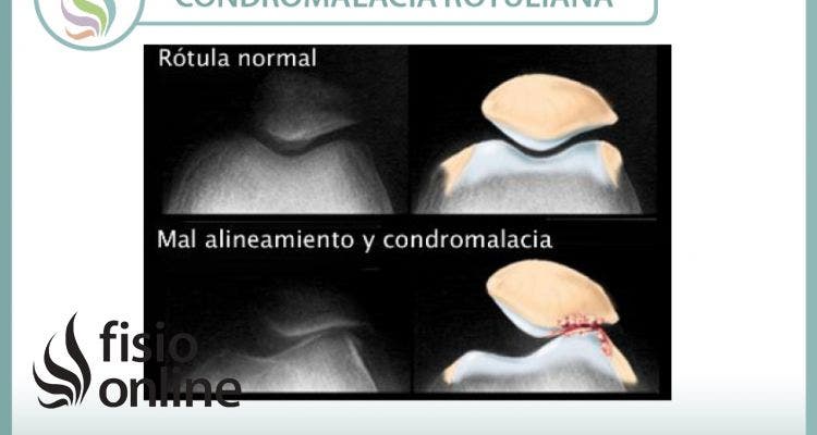 Condromalacia o condropatía rotuliana, causas, y tratamiento de una alteración mecánica