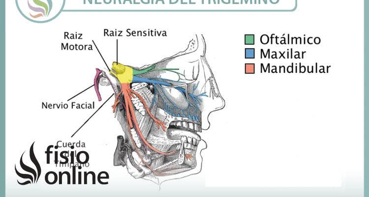 Neuralgia del trigémino. Un problema complejo