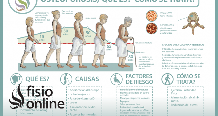 Descubre qué es y cómo se trata la osteoporosis u osteopenia