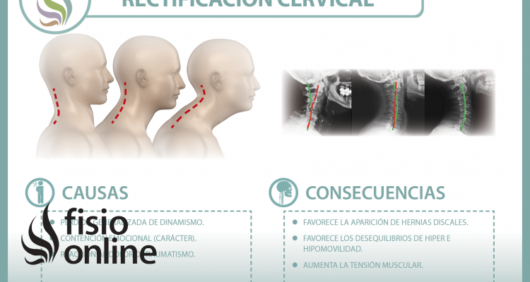 La rectificación cervical, una disfunción en auge, descubre qué es y a que se debe