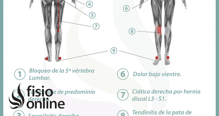 Relación entre el útero y el dolor de espalda