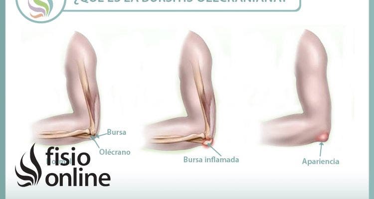 Descubriendo la bursitis olecraniana