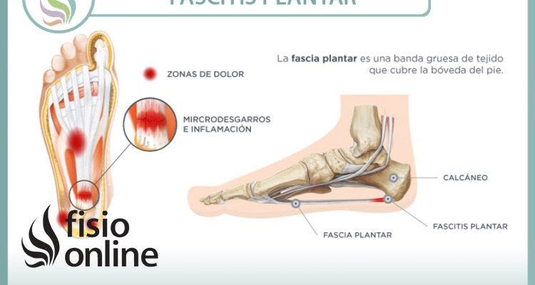 Fascitis plantar. Qué es, cuáles son sus causas y cómo podemos tratarla