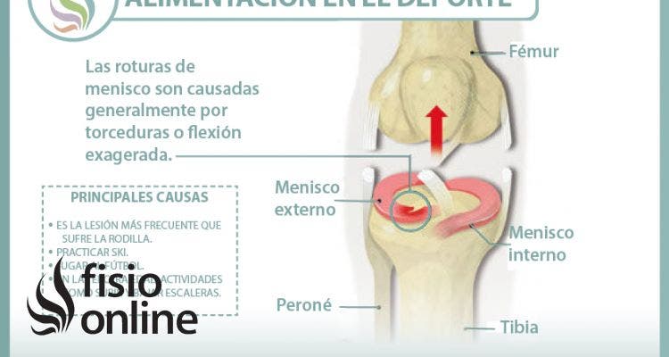 Conoce lo que supone una rotura de menisco, sus causas, consecuencias y tratamiento