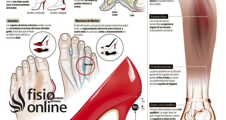 Consecuencias del abuso de los tacones. Daños en el tendón de Aquiles, juanetes, dedo martillo, neuroma de Morton