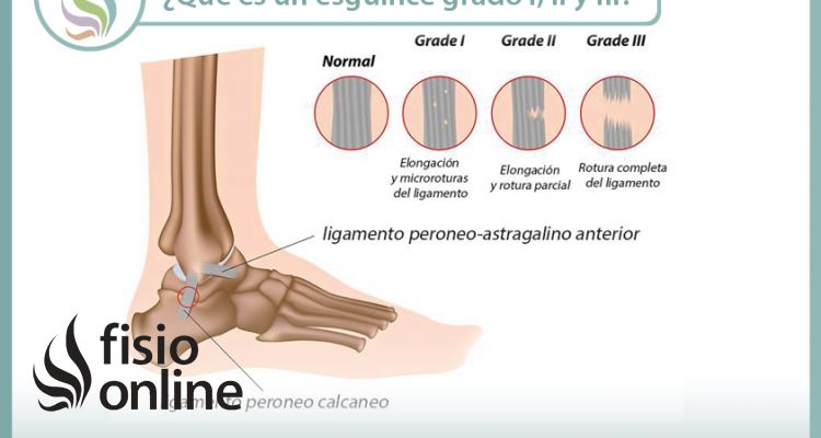 ¿Sabes qué es un esguince de tobillo y cuales son sus grados, según la importancia de la lesión?