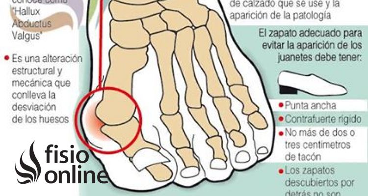 Hallux valgus o juanete, aprende un eficaz automasaje para tratarlo