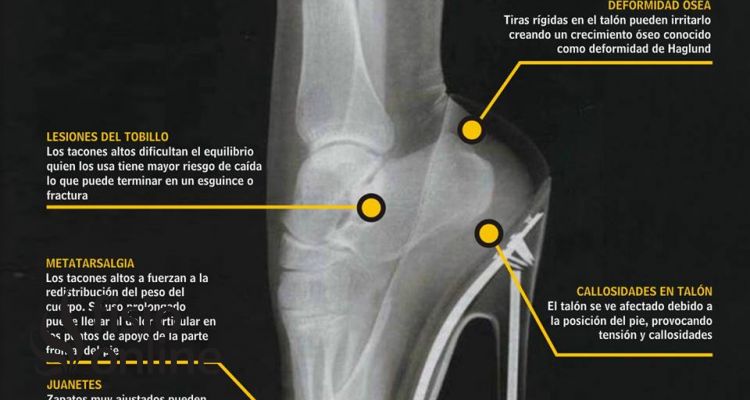 Juanetes, lesiones de tobillo, metatarsalgia, callosidades en el talón, deformidad ósea, consecuencia de los tacones