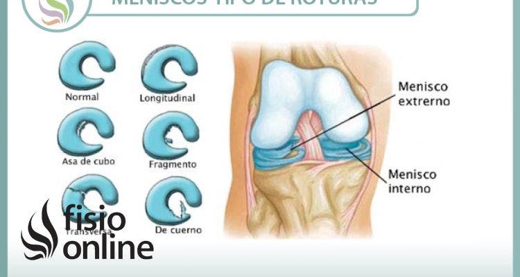 No hay dos rodillas iguales, ni dos lesiones de menisco iguales, aprende algunas diferencias
