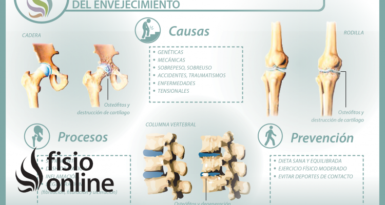 La artrosis, una visión como consecuencia del envejecimiento