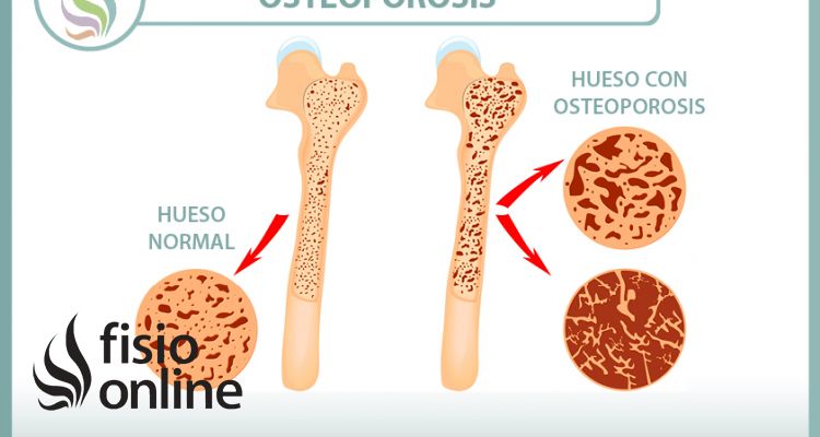 Explicando la osteoporosis