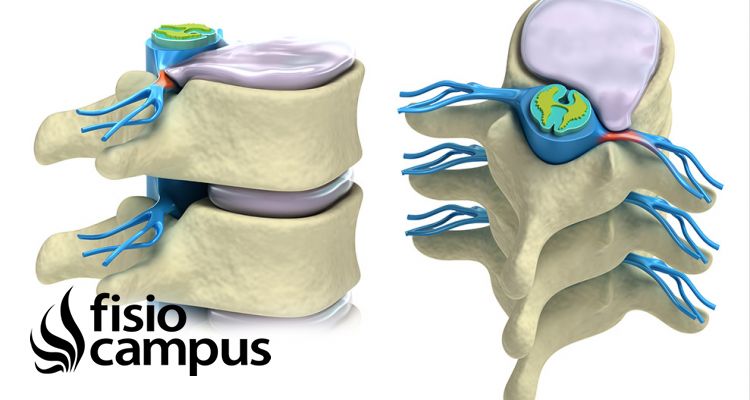 Hernias Discales Fisioonline 9482