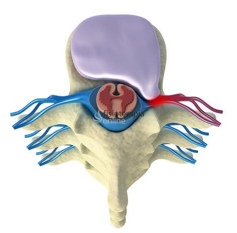 Anulus fibroso discal discount prominente