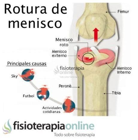 Causas, Consecuencias Y Tratamiento De La Rotura De Menisco ...