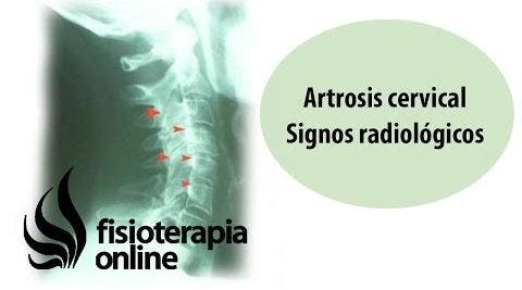 Artrosis cervical - Signos radiológicos | Fisioterapia Online