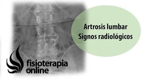 Artrosis lumbar - Signos radiológicos | Fisioterapia Online