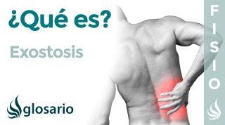 EXOSTOSIS | Qué es, qué afecta, síntomas, signos clínicos, causas y tratamiento fisioterapéutico