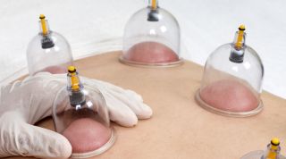 La tÃ©cnica de Cupping o Ventosas, Â¿Tiene verdaderos efectos o es un placebo?