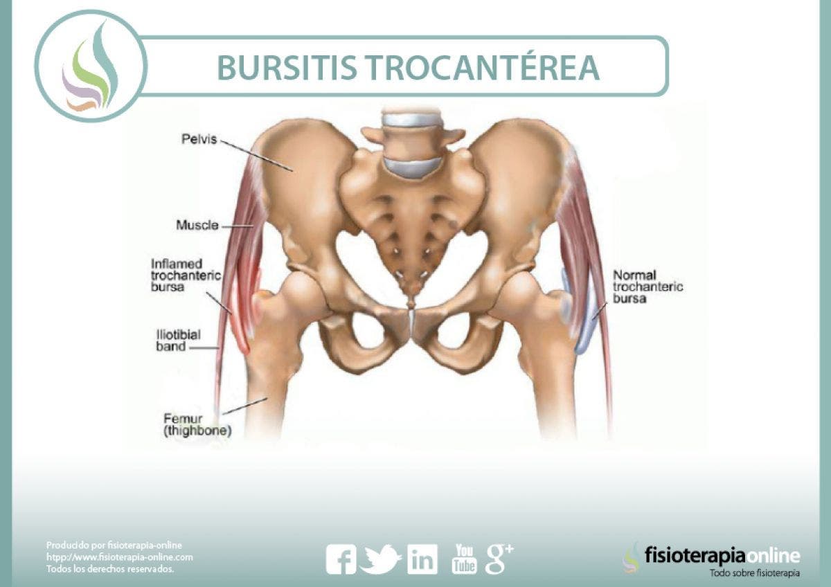 trocanteritis o bursitis trocanterea 