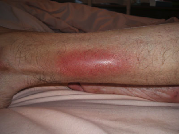 flebitis-tratamiento-dolor--pierna