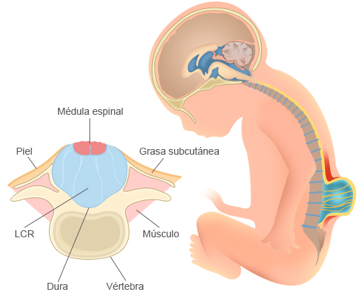 Â¿QuÃ© es la espina bÃ­fida y cuÃ¡l es su tratamiento en fisioterapia?