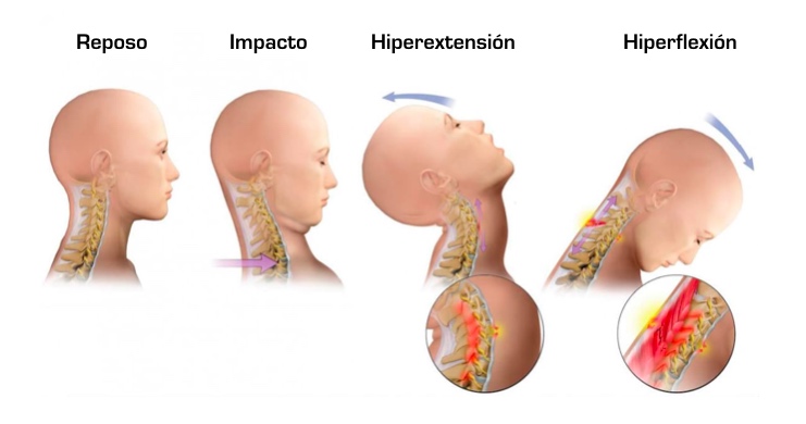 Como dormir 2025 con esguince cervical