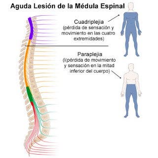 signos de la tetraplejia